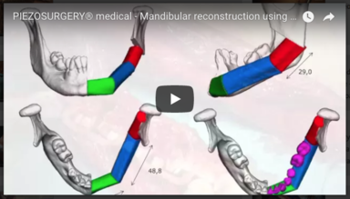 Mandibular reconstruction using a fibula cutting edge - Dr. Paolo Iacoviello - Ospedali Galliera - Genoa (IT)