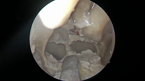 Sphenoidotomy performed with MP6 L surgical insert (cadaver lab)